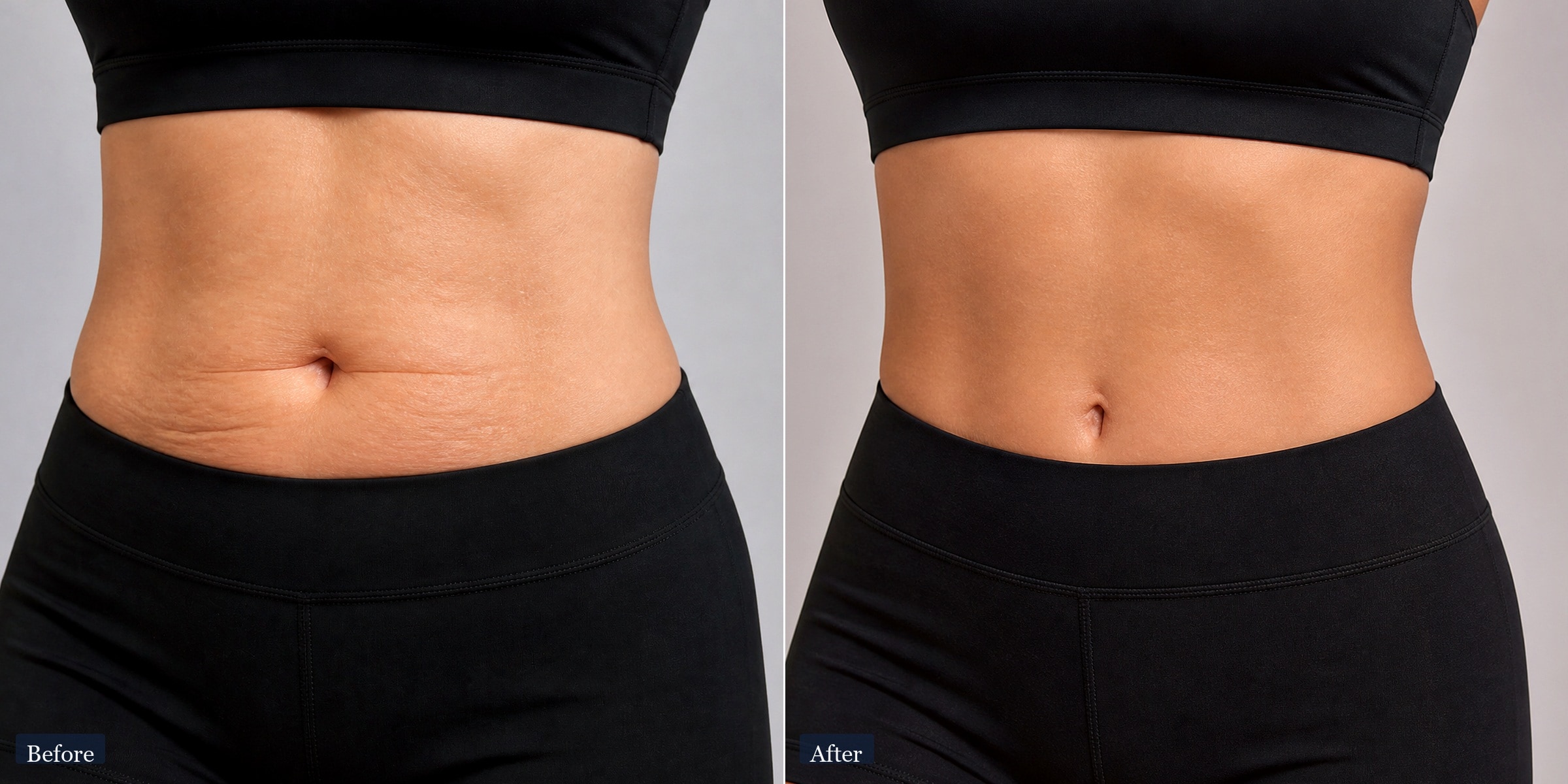 Before and after abdomen contouring with V-FORM — individual results vary