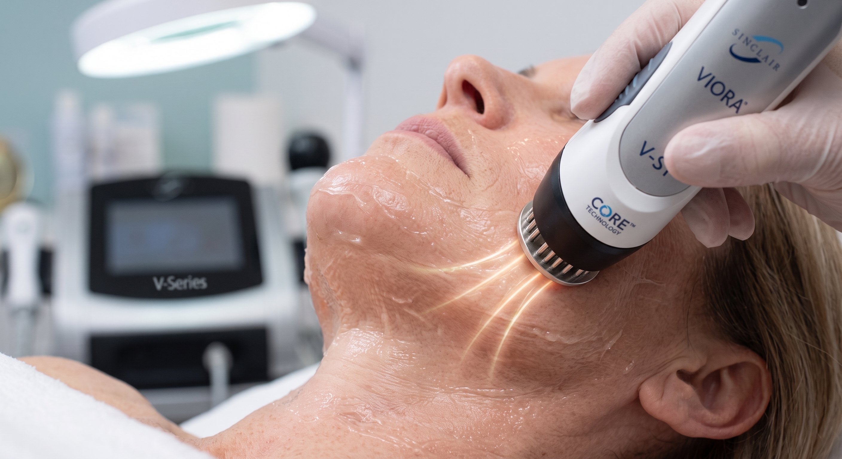 Firm, smooth facial skin after physician-guided V-ST tightening
