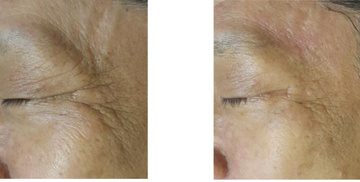 Before and after V-ST body skin-tightening results