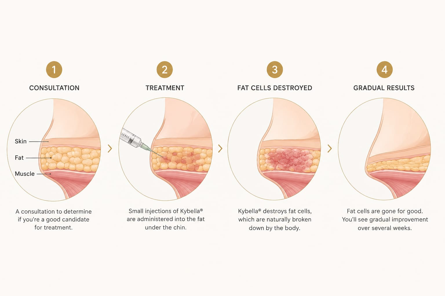 Kybella submental-contouring treatment process
